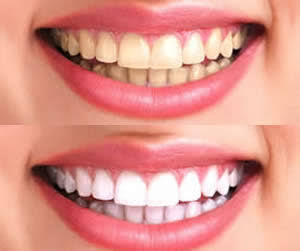 BLANQUEADOR DENTAL